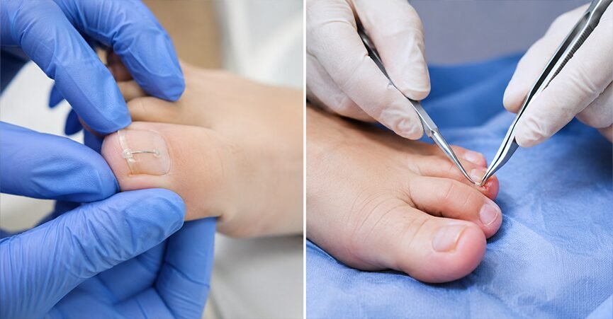 Side-by-side comparison showing a podiatrist applying a nail correction brace on the left, and performing traditional ingrown toenail surgery with medical instruments on the right.